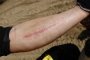 Tại sao có vết sẹo dài trên cẳng tay các tay đua Moto GP?
